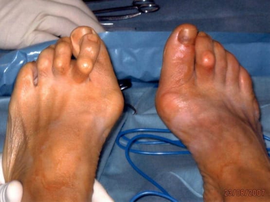 Hallux valgus - Ein sehr häufiges Fussproblem